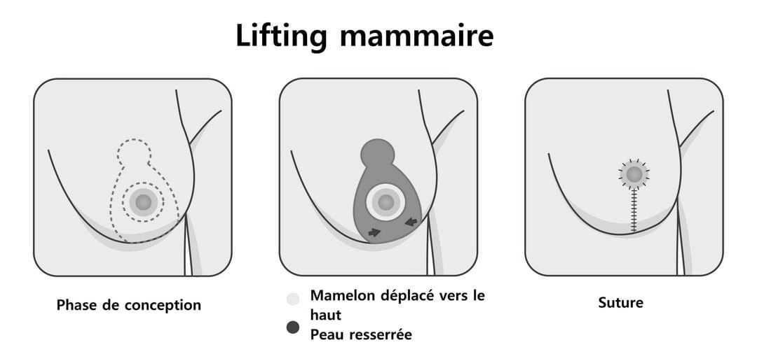 lifting mammaire Suisse 