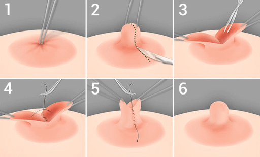 chirurgie du mamelon Genève